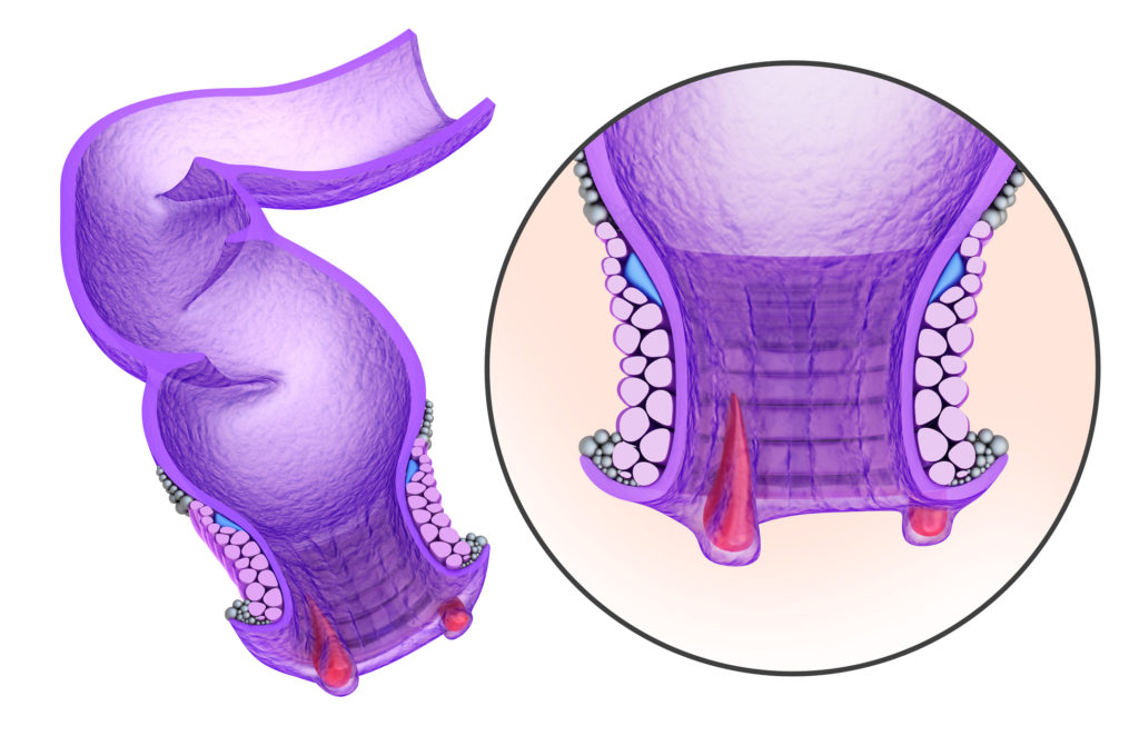 Hemorrhoids : Anal disorders in details, xray view.