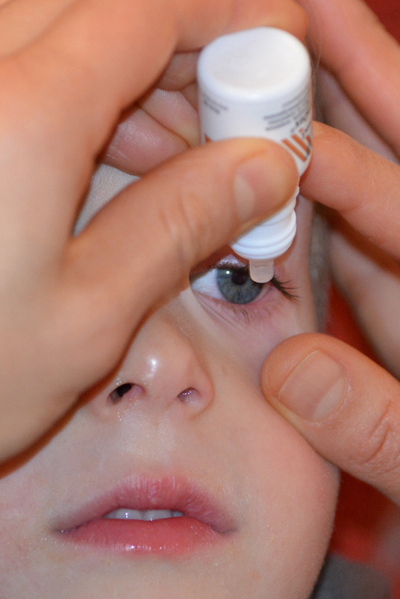 Atropine Eye Drops for Myopia being used on a child.